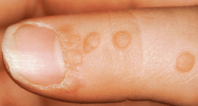 verrue vulgaire sur les doigts